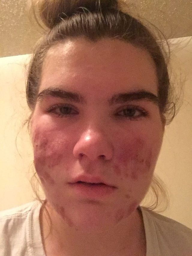 Grace before: front view, with cystic acne on both cheeks