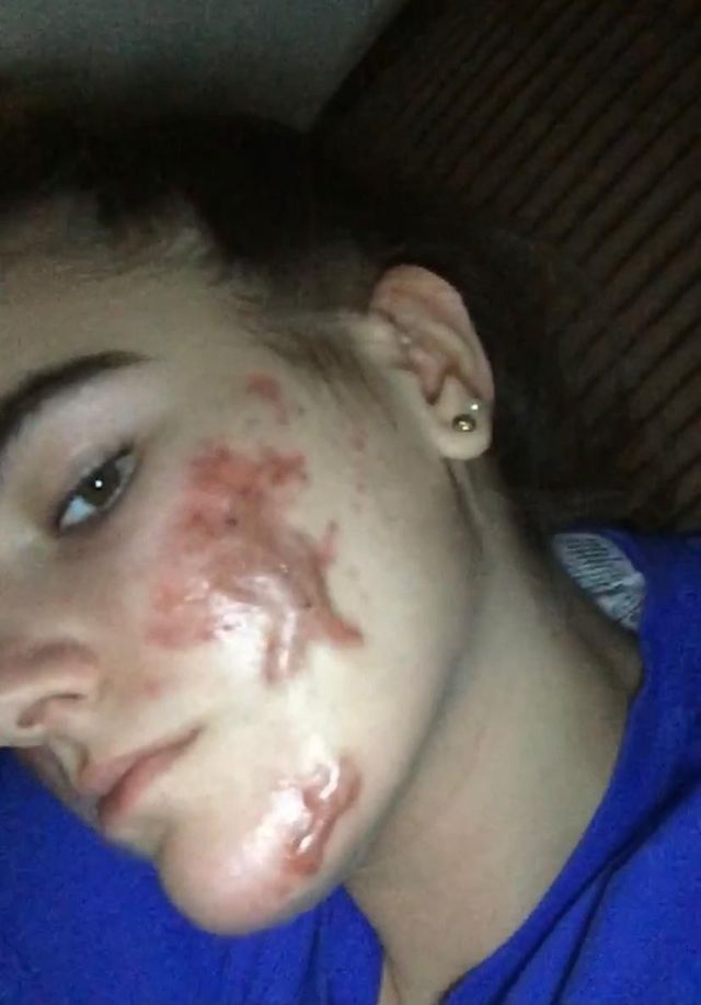 Grace before: side view, with cystic acne on her cheek and jaw