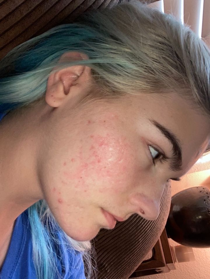 Grace after, side profile with platinum and blue hair: a few small red spots