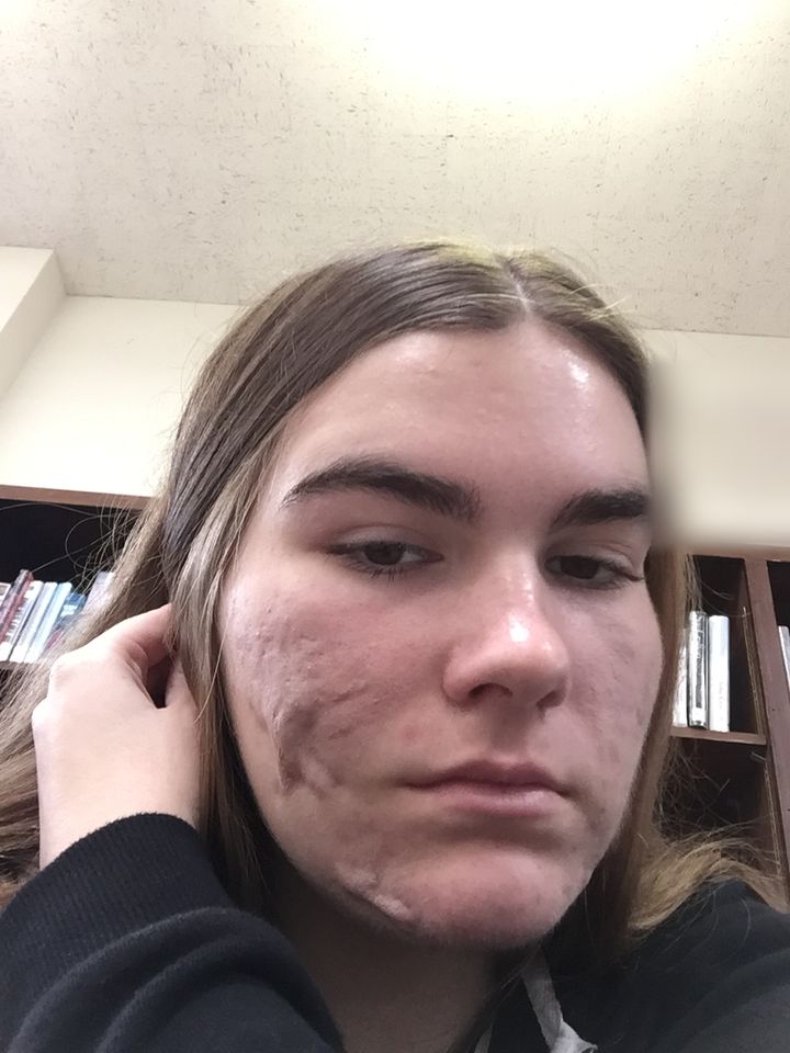 Grace healing: cysts gone, with scarring and redness left on her cheeks