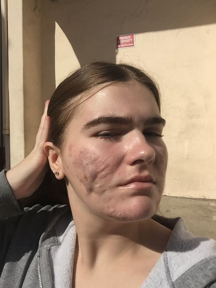 Grace healing, outdoors in the sun: scarring and a few spots left
