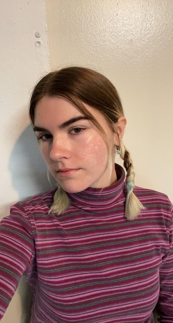Grace two years later, in pigtails and a striped turtleneck, skin clear