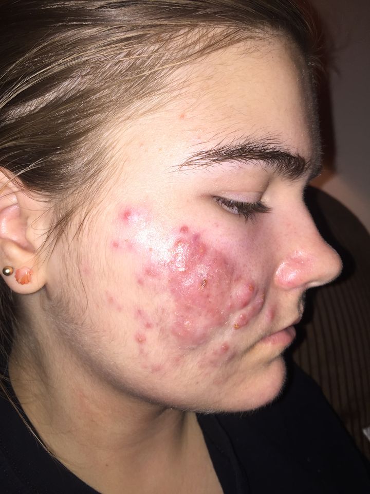 Grace at her worst: right side of her face, with severe inflamed cysts on her cheek