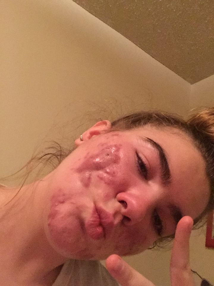 Grace at her worst: selfie showing severe cysts on her cheek and jaw