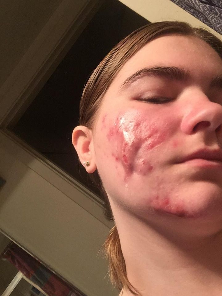 Grace at her worst: close-up of severe cysts on her cheek